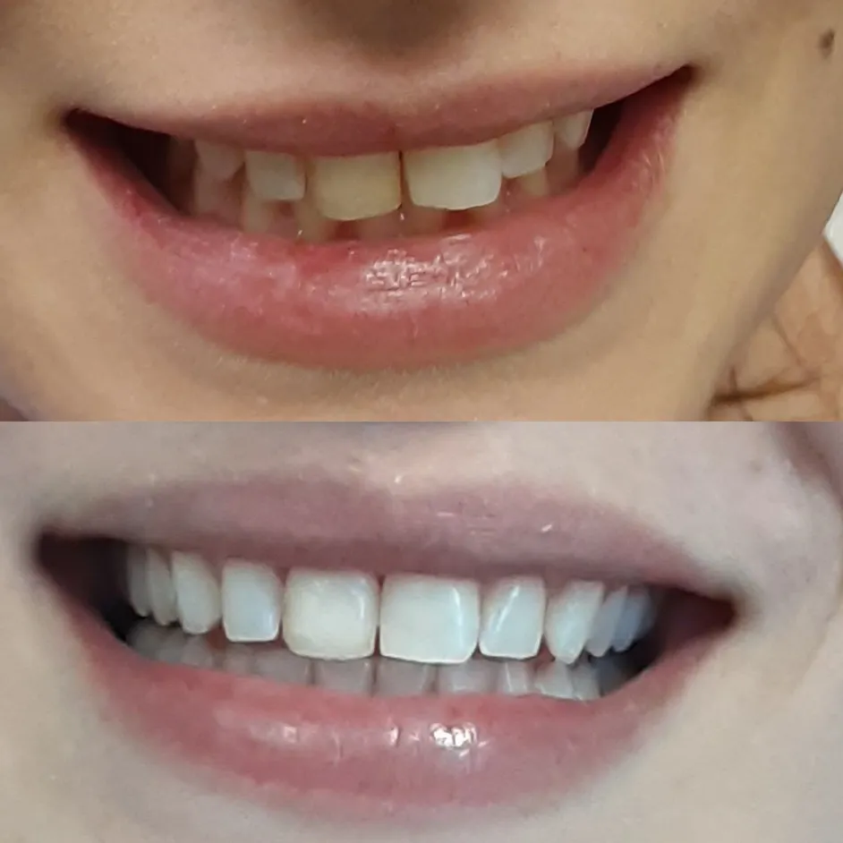 invisalign