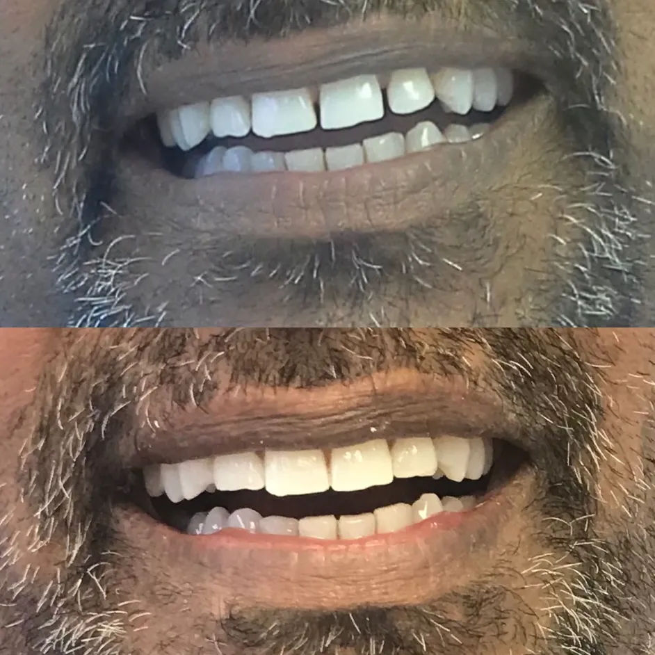 invisalign