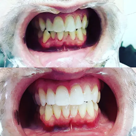 invisalign