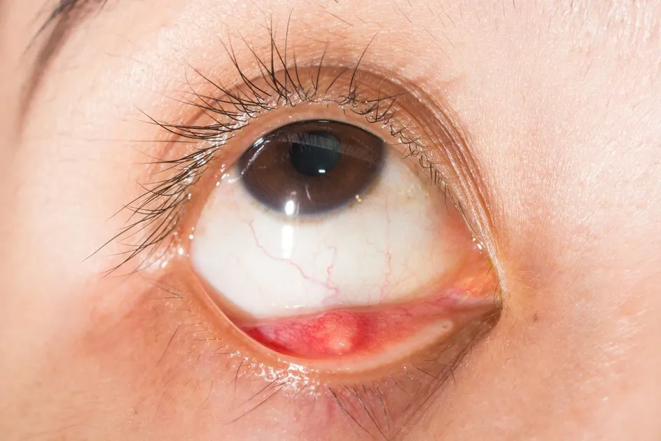 Meibomian Gland Disease