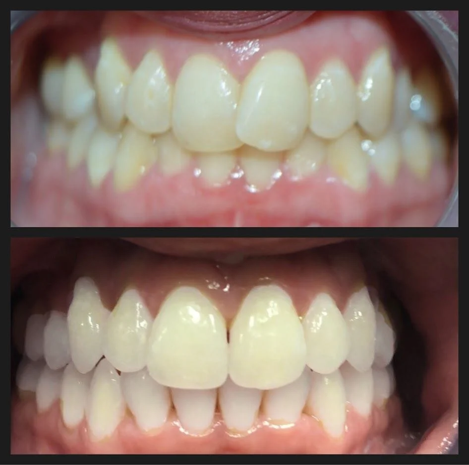Clear Aligner Before and After