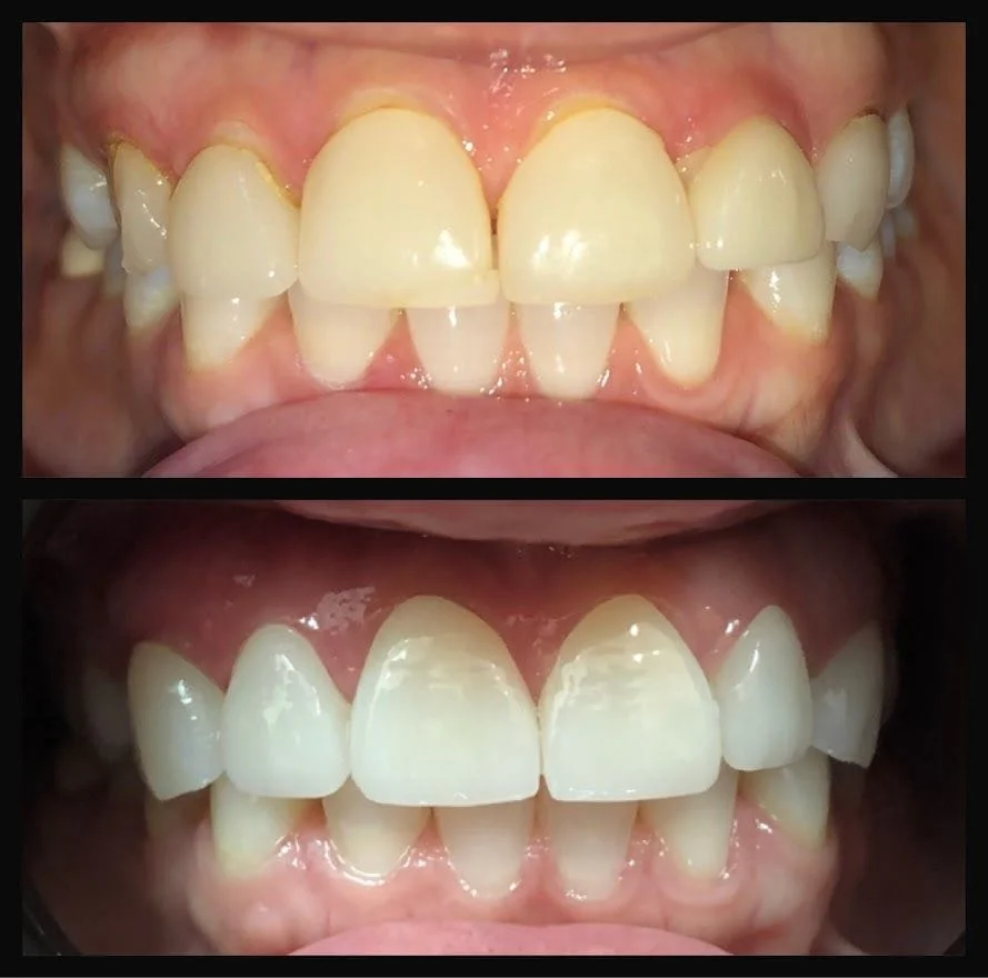 Crown and Veneer Before and After