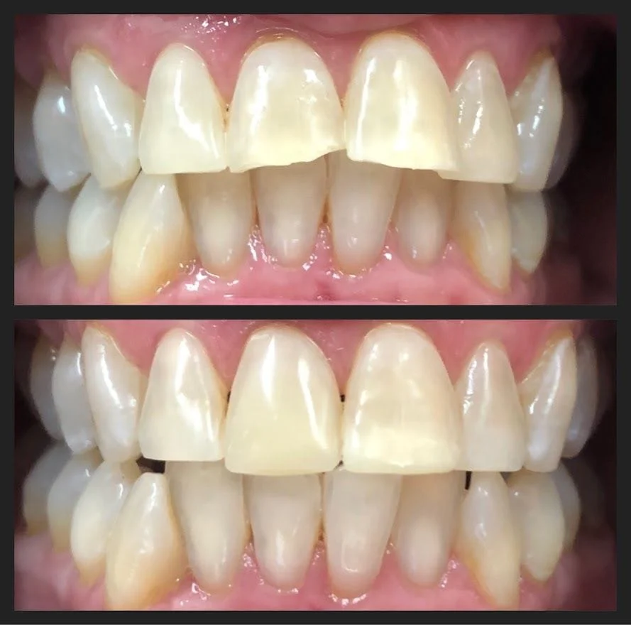 Bonding for Chipped or Broken Teeth Before and After