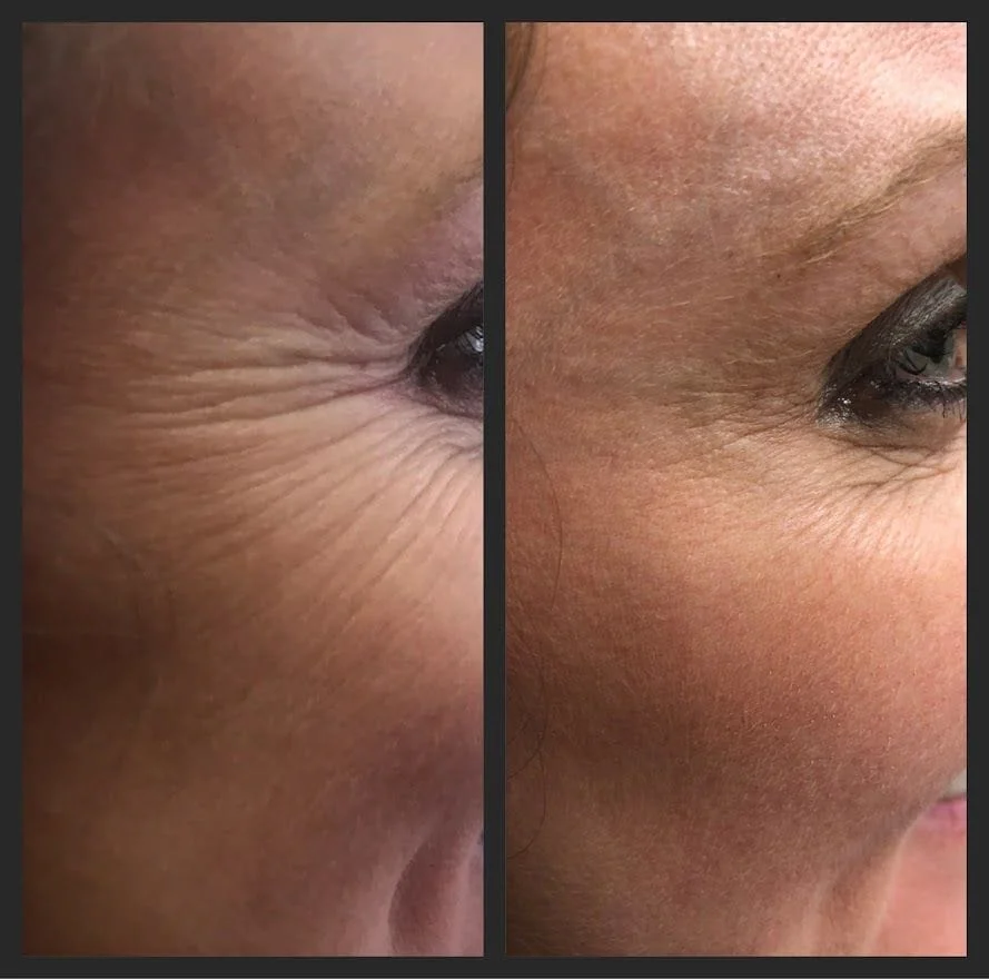 Crows Feet Botox Before and After