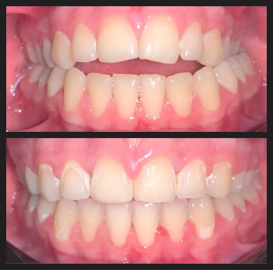 Traditional Ortho Before and After