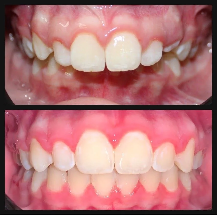 Traditional Ortho Before and After