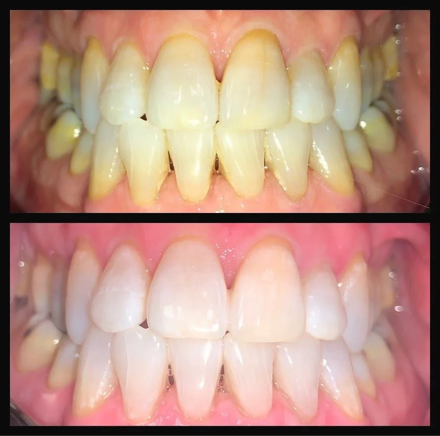 KOR Whitening Before and After