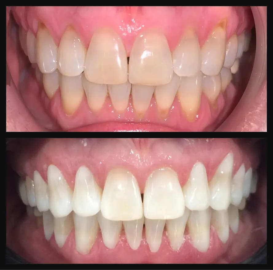 KOR Whitening Before and After