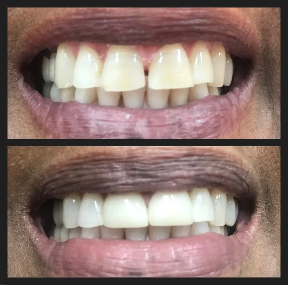 Crown and Veneer Before and After