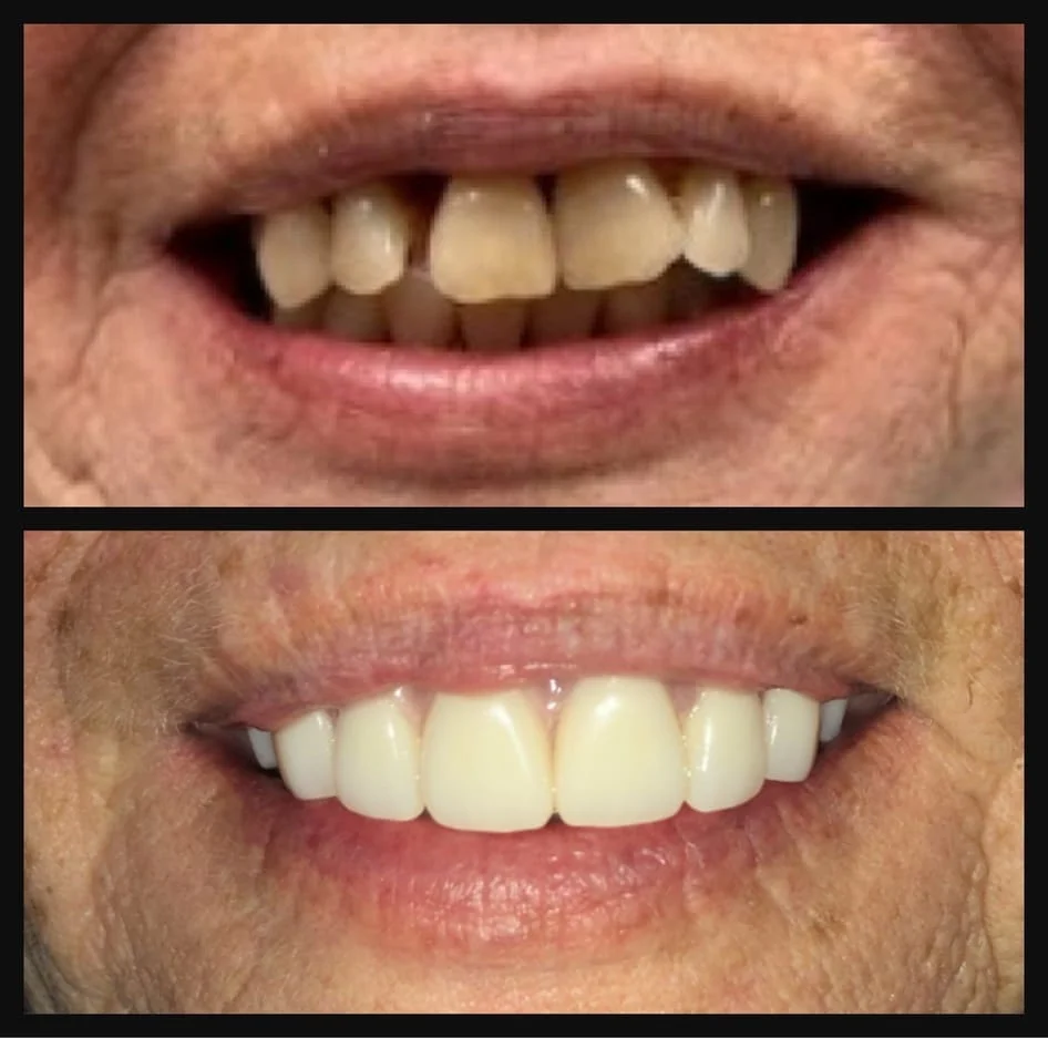 Denture and Partial Before and After
