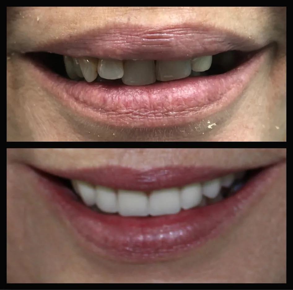 Denture and Partial Before and After