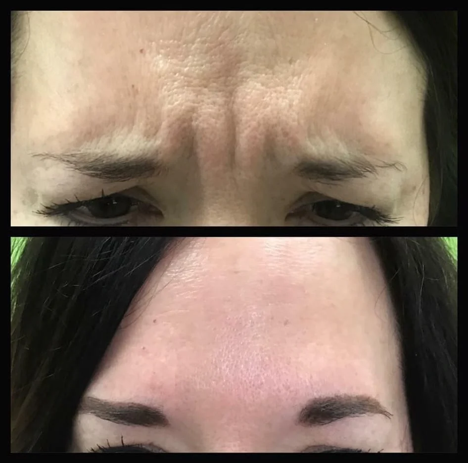 Glabella (Frown Lines) Botox Before and After