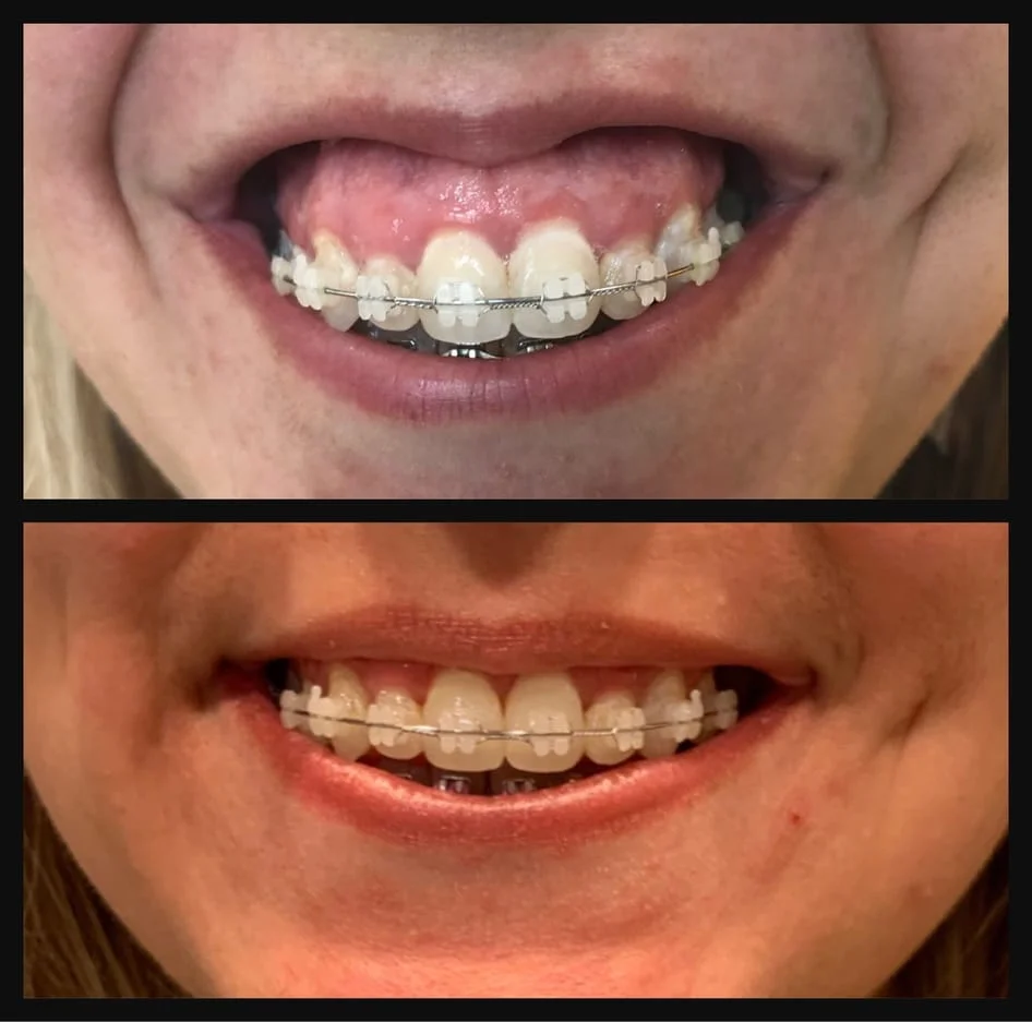 Gummy Smile Botox Before and After