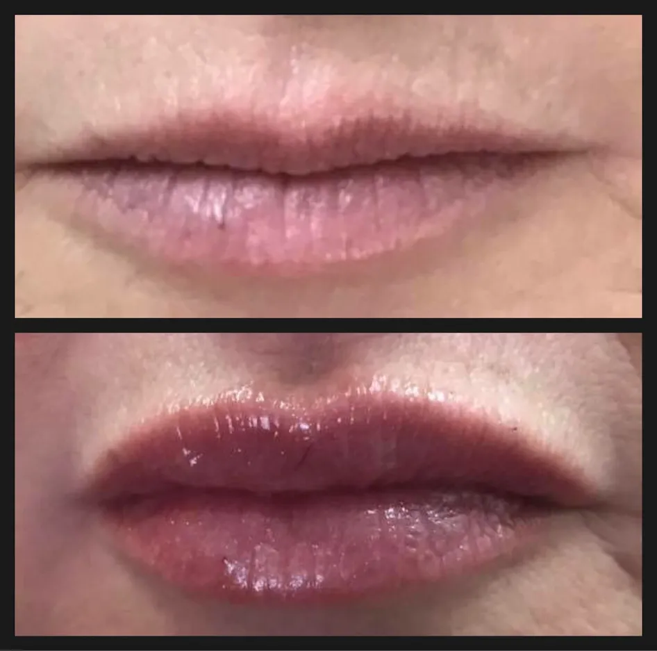 Juvederm Lip Enhancement Before and After