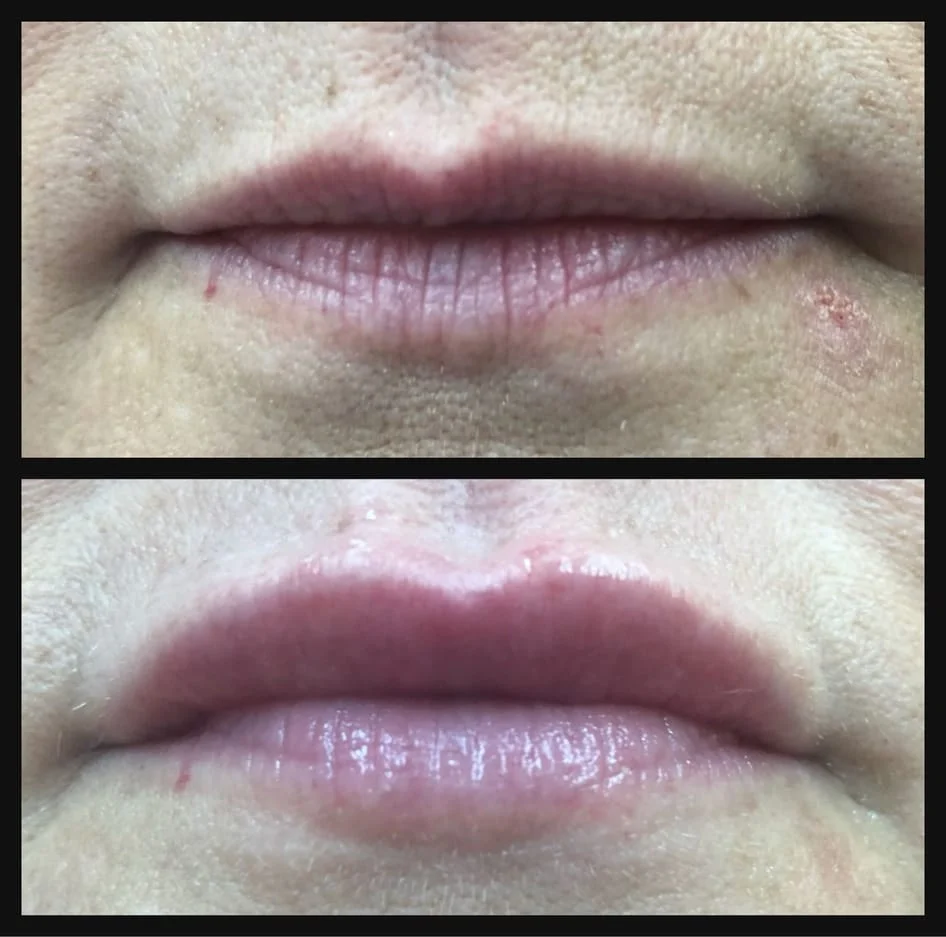 Juvederm Lip Enhancement Before and After