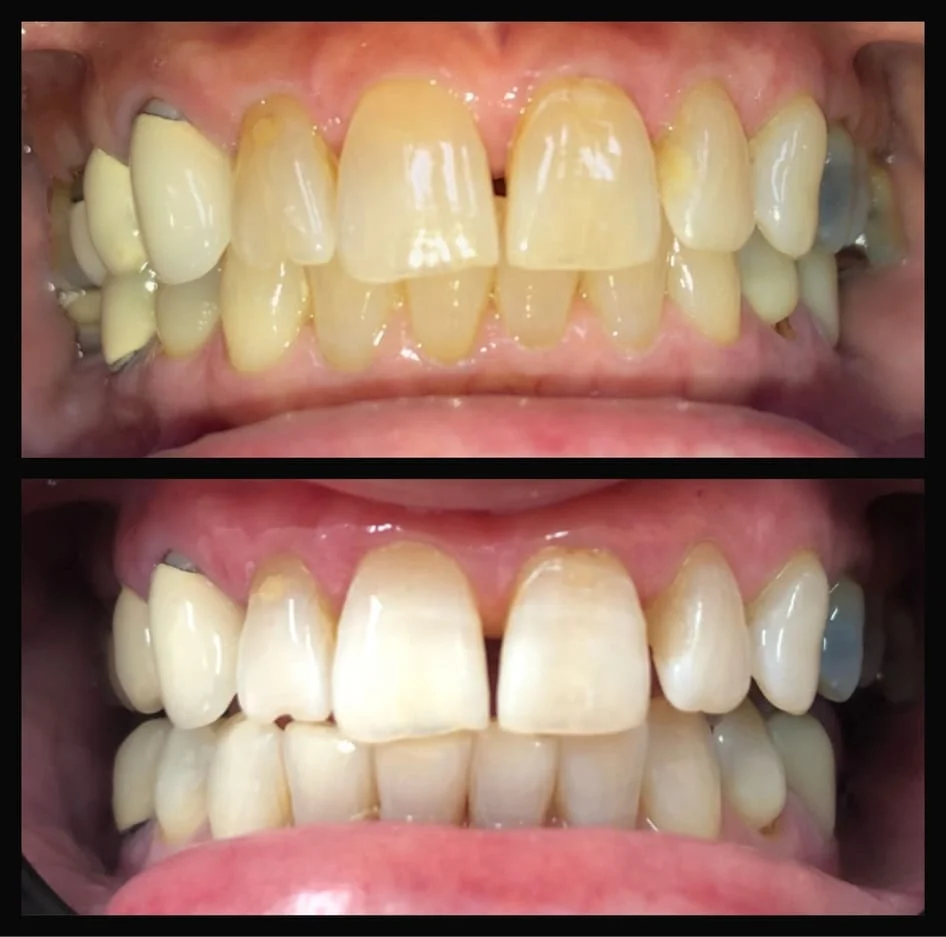KÖR Whitening Before and After