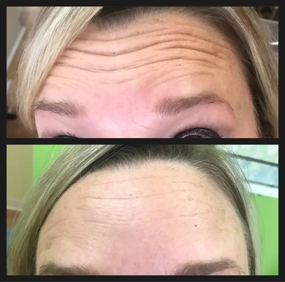 Upper Forehead Botox Before and After