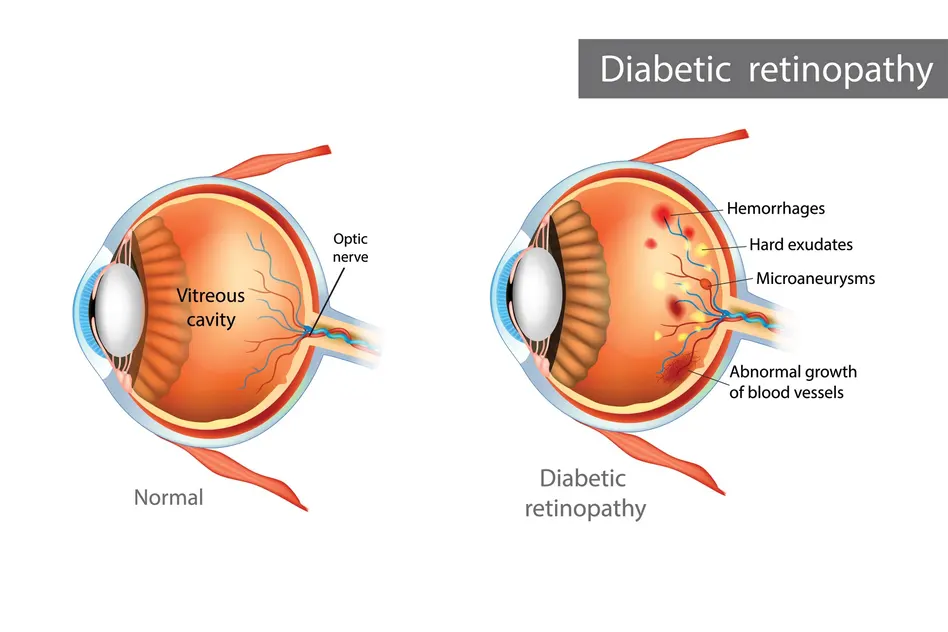 diabetic retinopathy