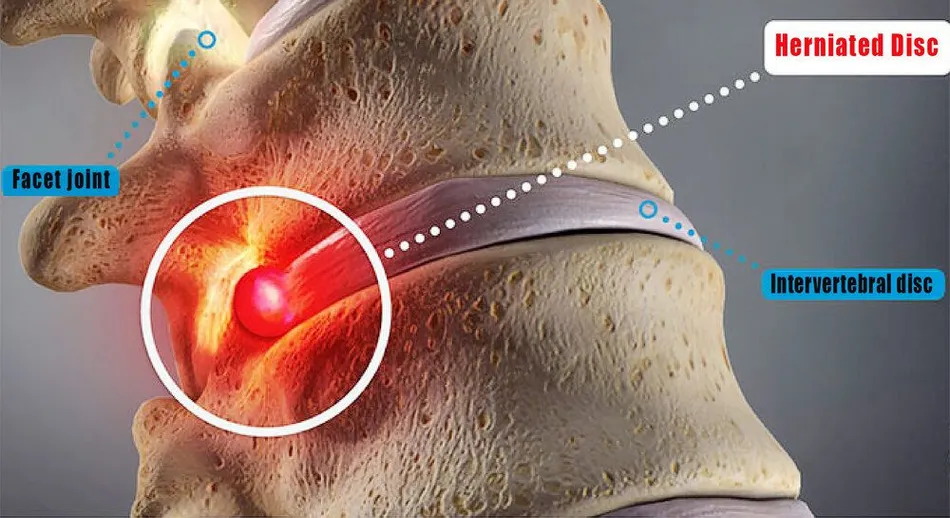 Herniated Disc Model