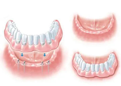 Over Denture in Elmhurst, NY