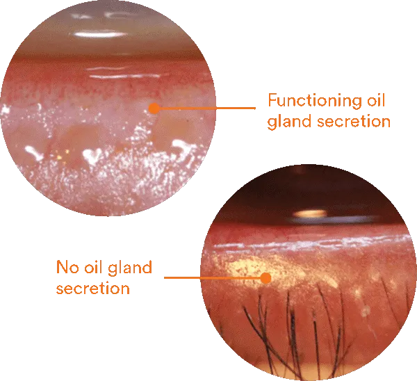 gland