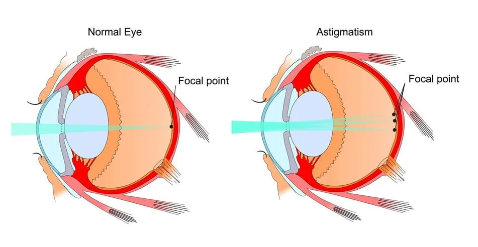 illustration of astigmatism