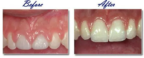 before and after images of teeth after crown lengthening, periodontist Mahwah, NJ