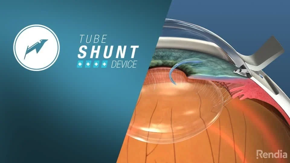 tube shunt device