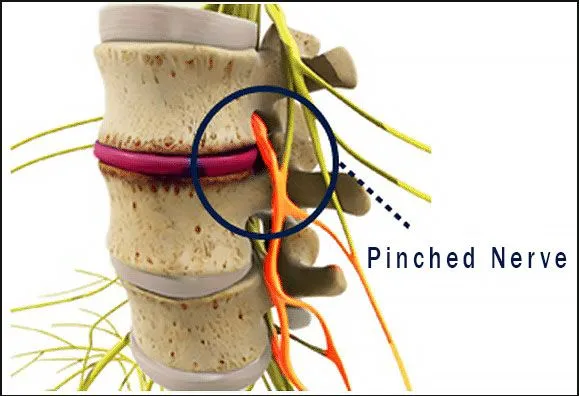 pinched nerve