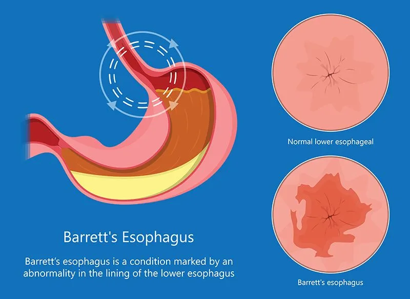 Detailed medical illustration showing the anatomy and changes of Barrett’s esophagus in the esophagus lining