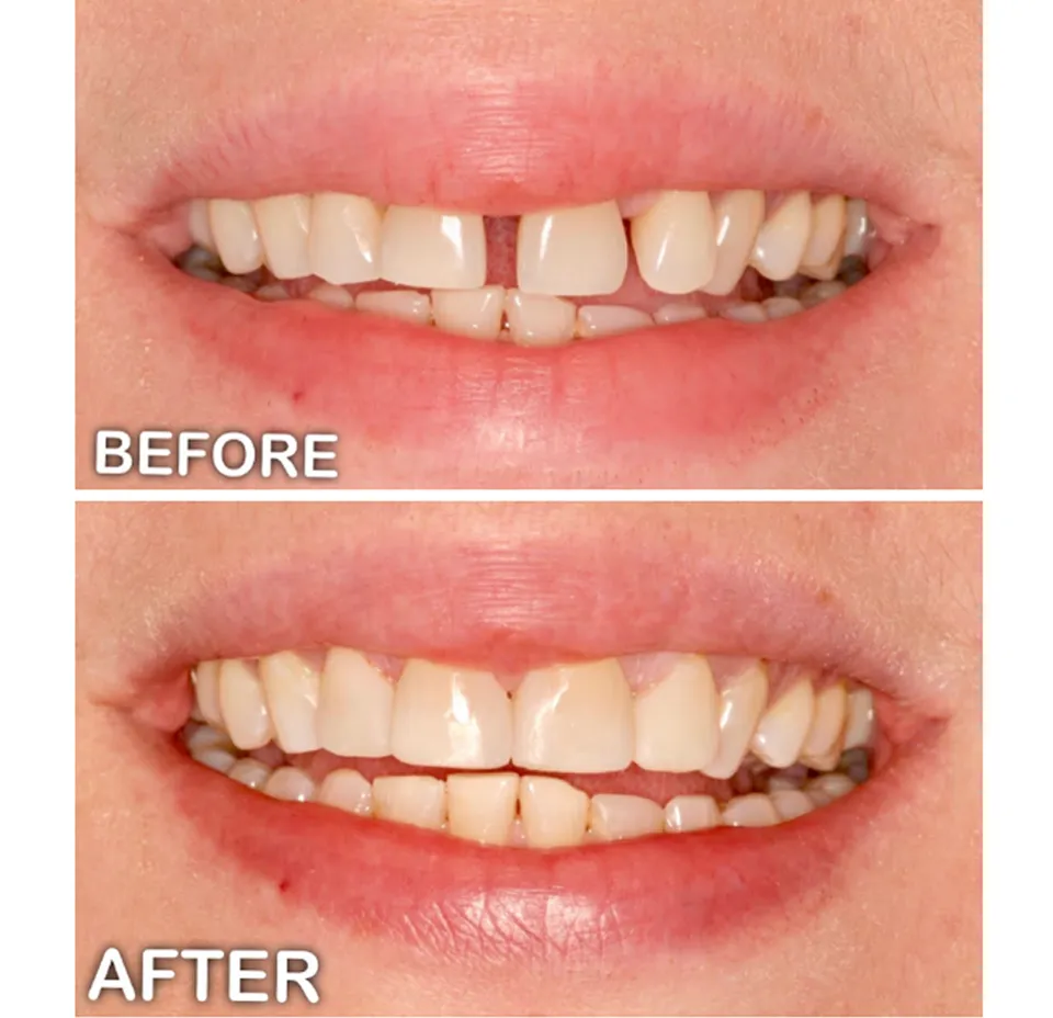 Before and After Cosmetic Dental Treatment - Dentist Yonkers NY