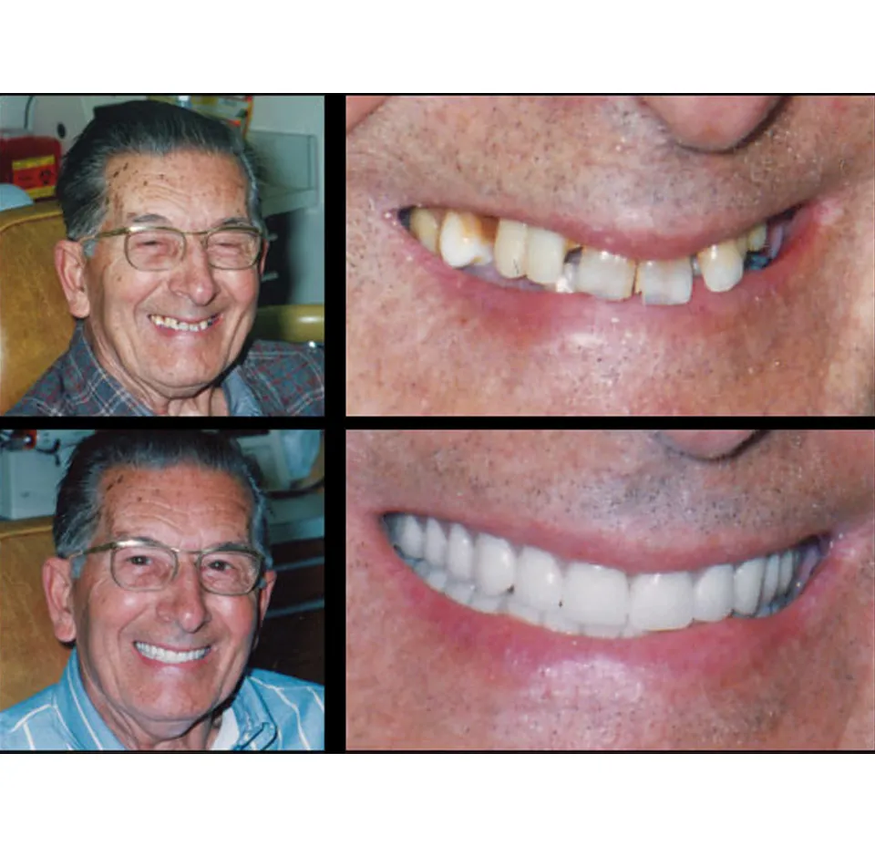 Before and After Dental Crowns - Dentist Yonkers NY