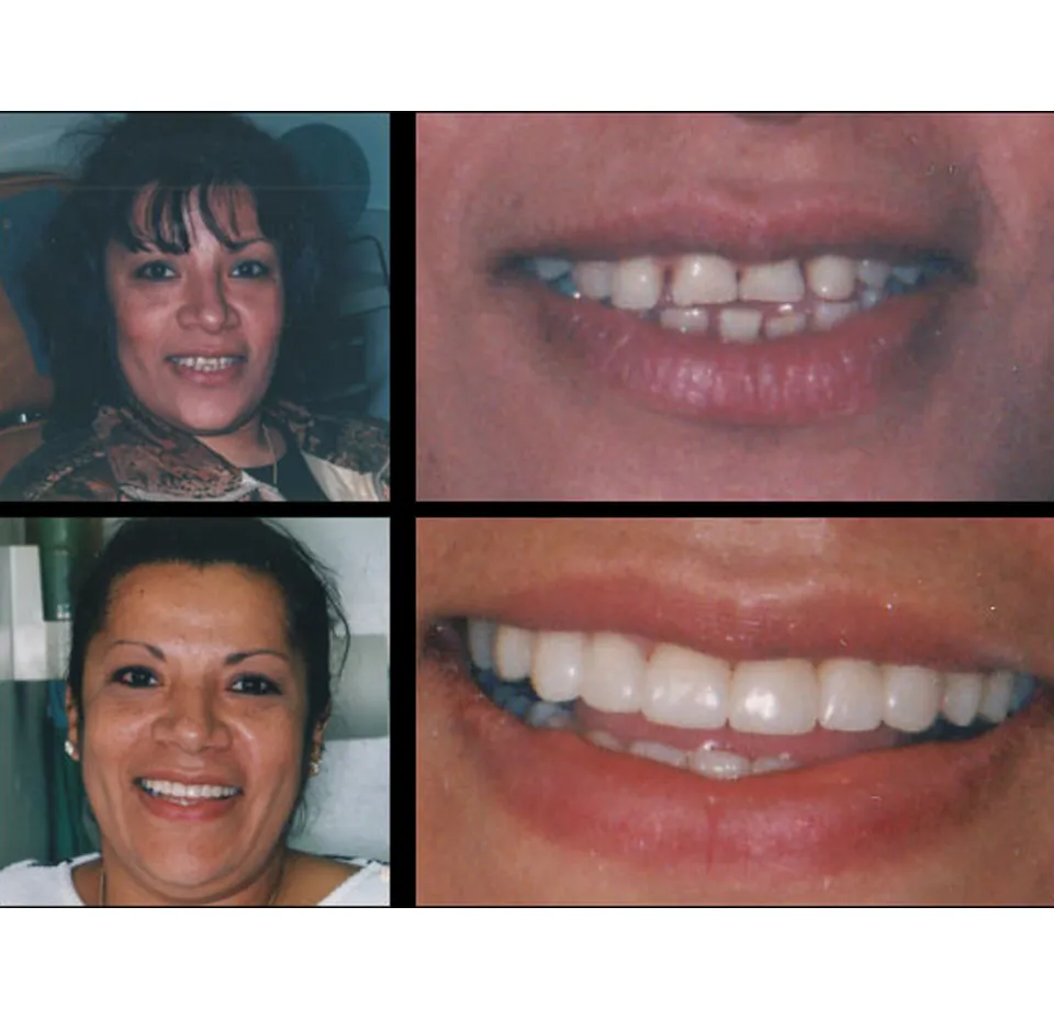 Before and After Dental Treatment - Dentist Yonkers NY