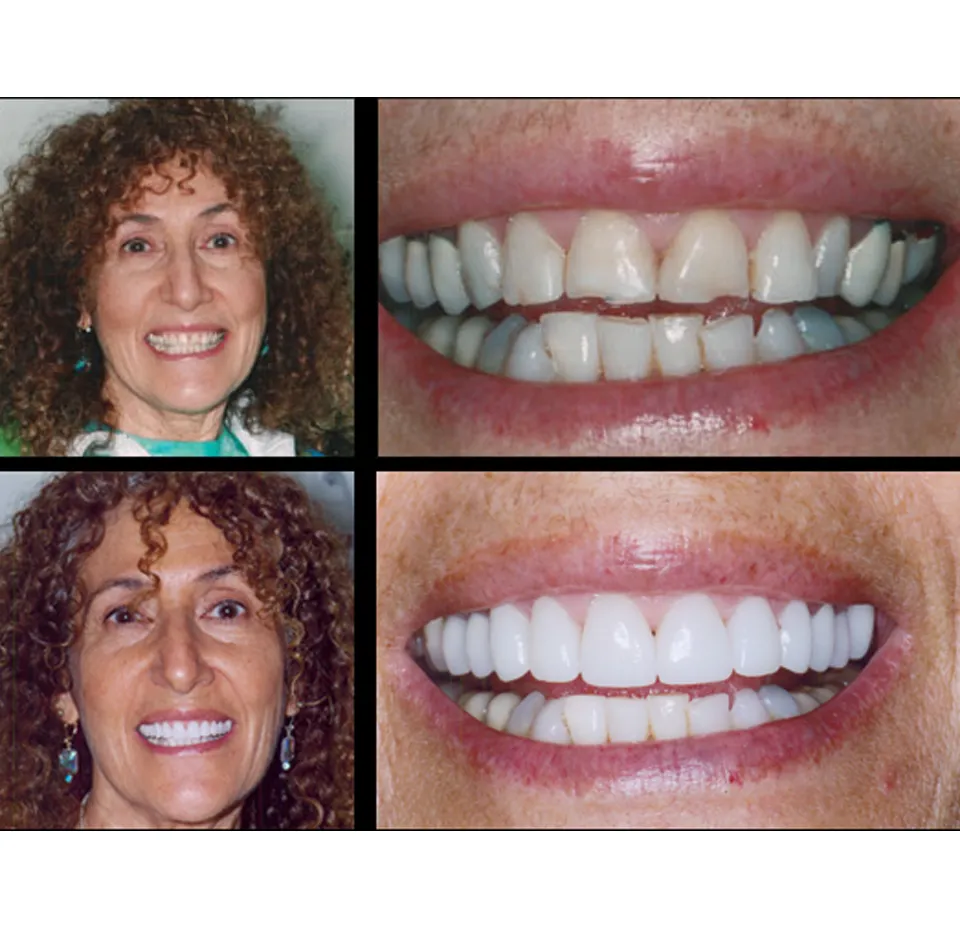 Before and After Dental Veneers - Dentist Yonkers NY