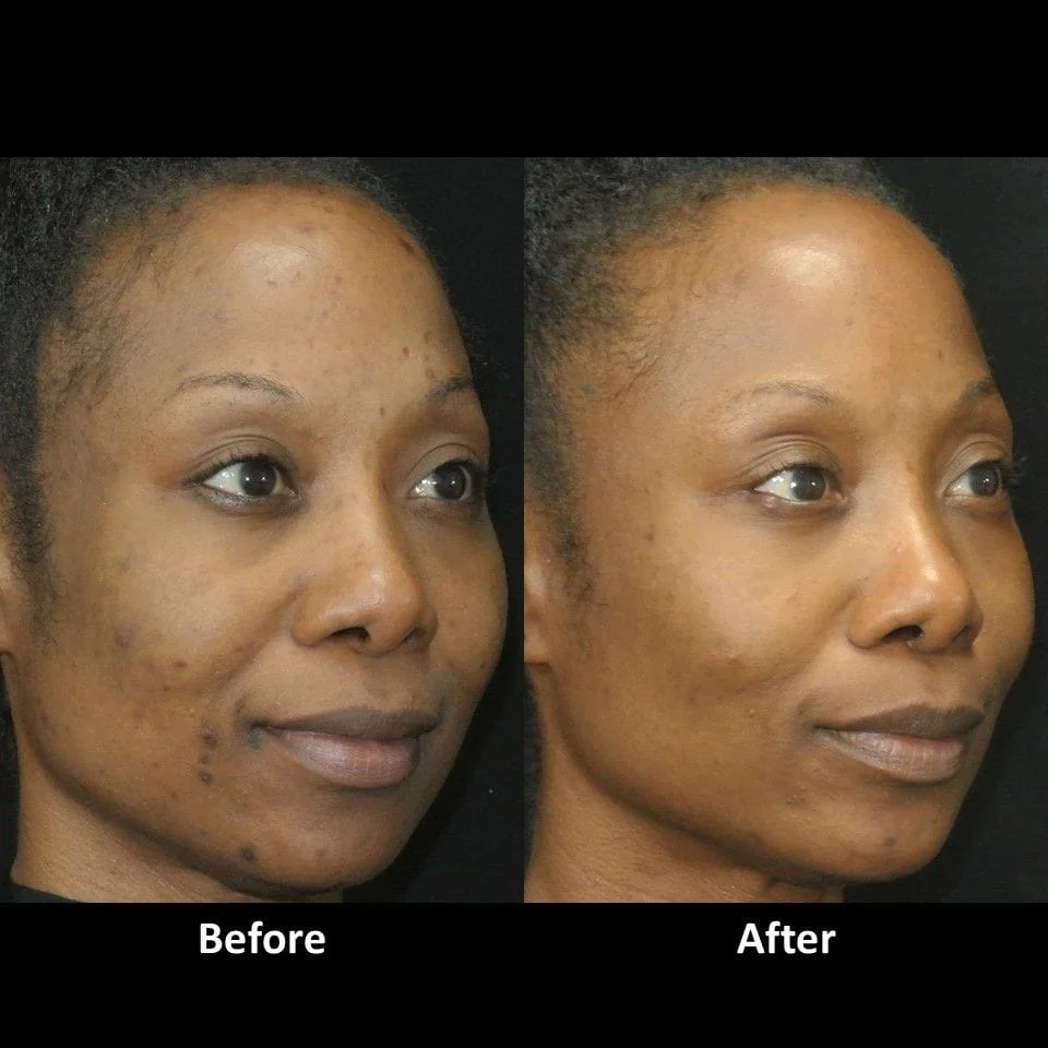 Micro Laser Peel before and after