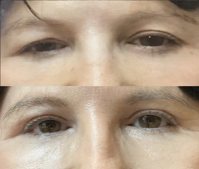 phoenix eyelid surgery lift bleph scottsdale matthew heller surgery