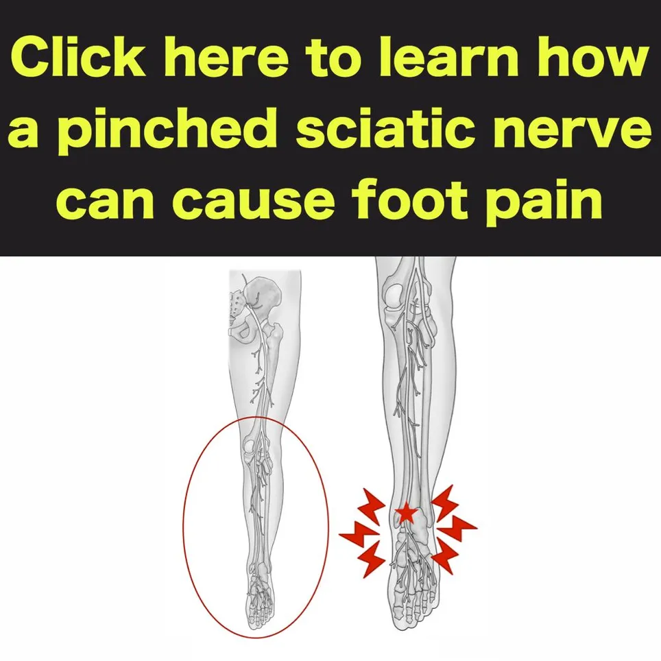 sciatica causing foot pain