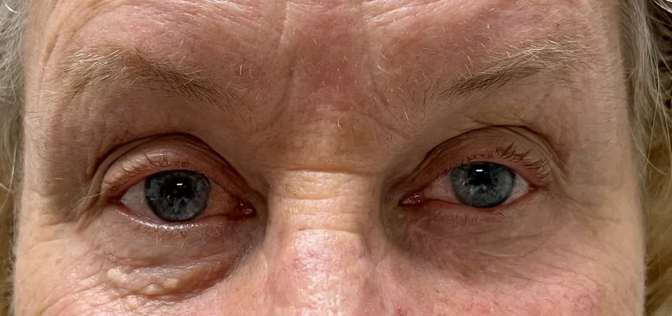 After-Xanthelasma-eyelid-lift-upper-blepharoplasty-scottsdale-phoenix-arizona-surgery