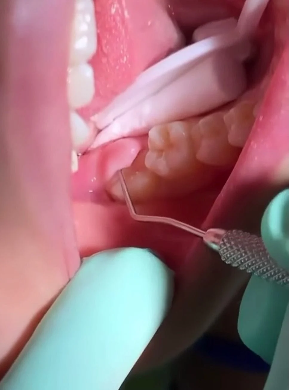 example of errupting molar