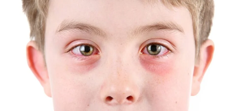 a kid having pink eye