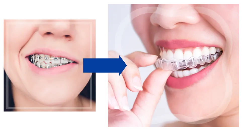 braces vs orthosnap