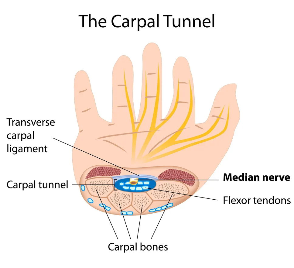 Carpal Tunnel Syndrome is an anatomical entrapment