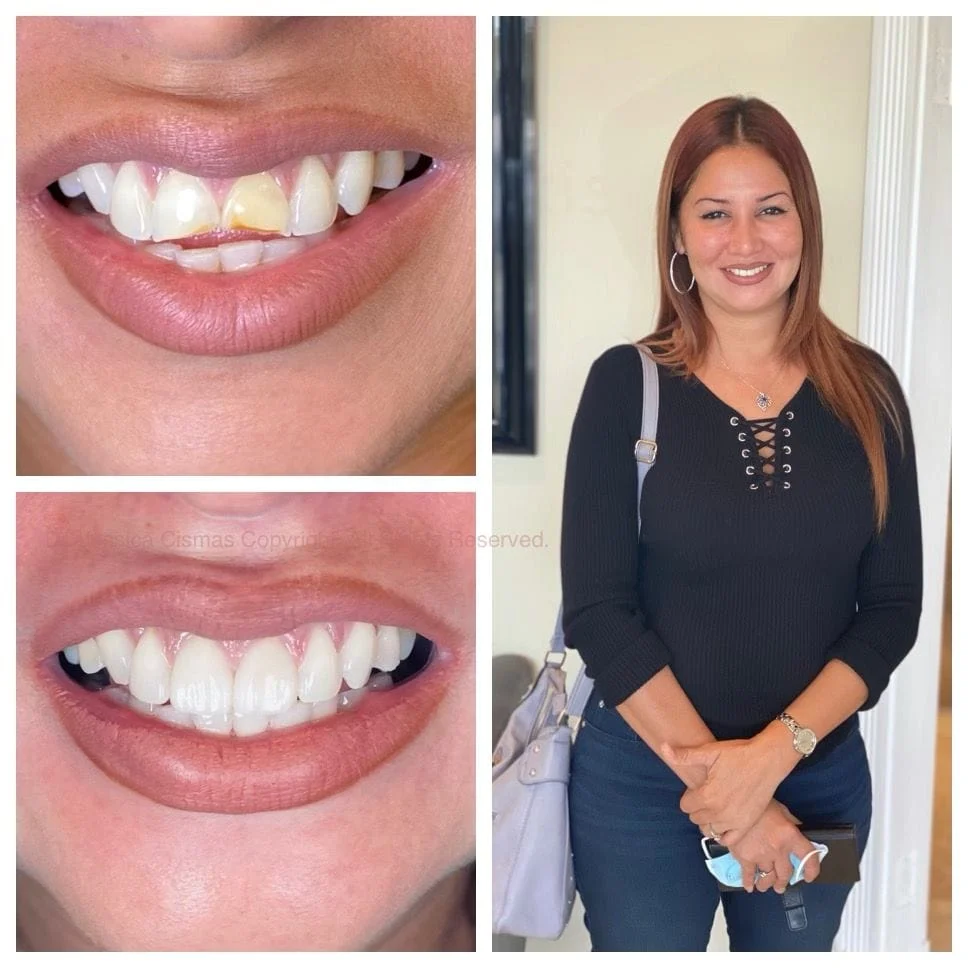 Did you know that with minimally invasive porcelain veneers restoration you can transform your smile? For details contact your local Aventura Dental Group dentist.