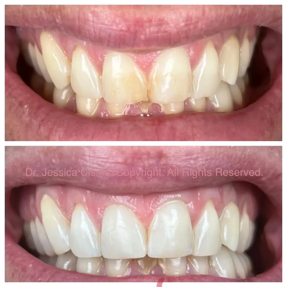 Aventura Dental Group specializes in full mouth restorations. We are one of the top cosmetic dental practice in Aventura and Miami withn over 757 5 star reviews.