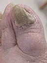 Fungal toenail