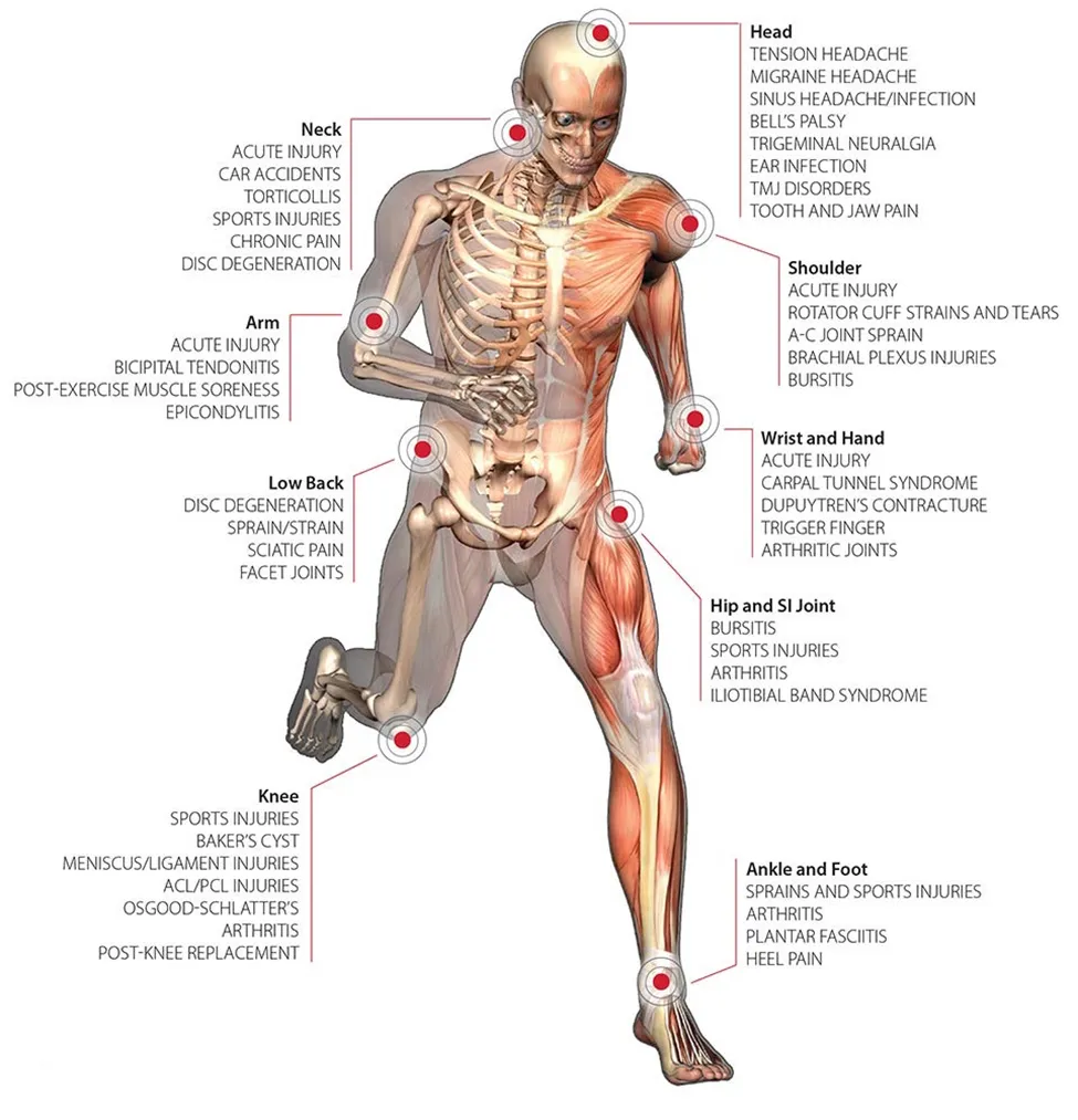 Muscular Skeleton showing areas which can be treated with Laser