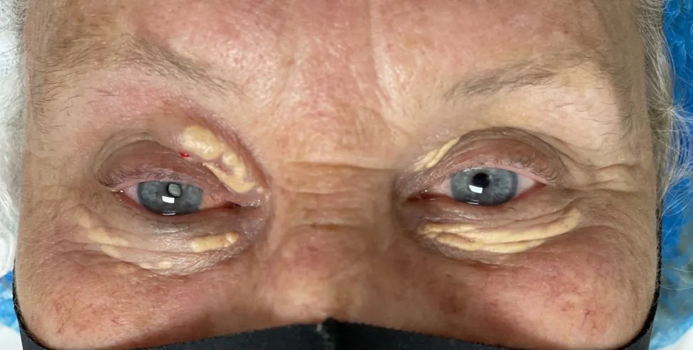 Xanthelasma-cholesterol-deposits-before-blepharoplasty-eyelid-lift-phoenix-az-eye-doctor