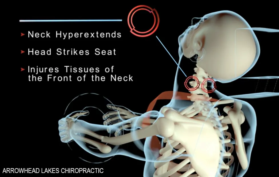 Video of the effects of whiplash