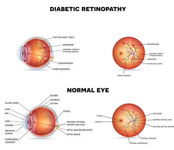 Illustration of Diabetic Retinopathy