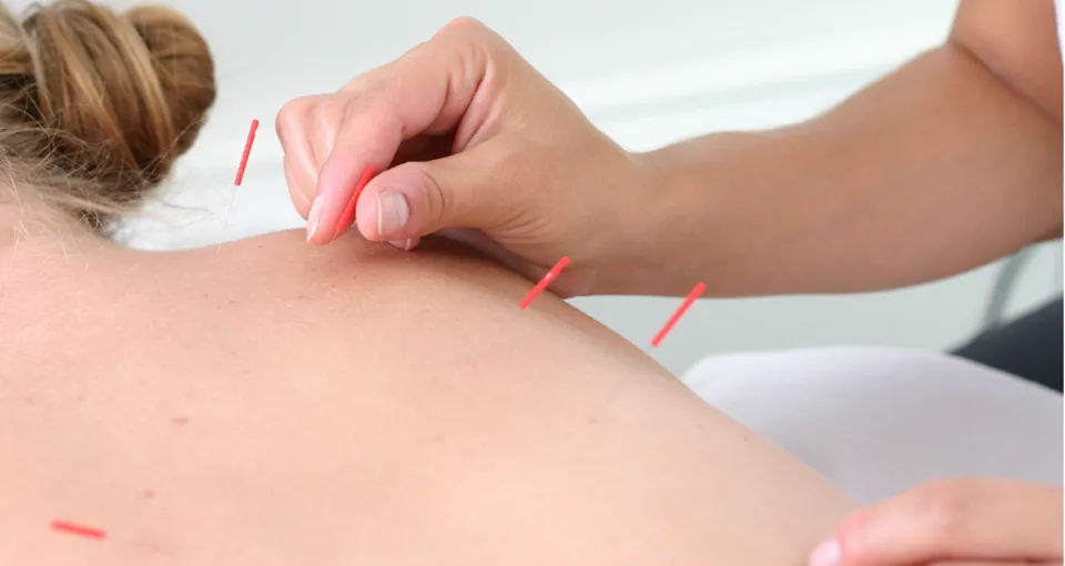 acupuncture